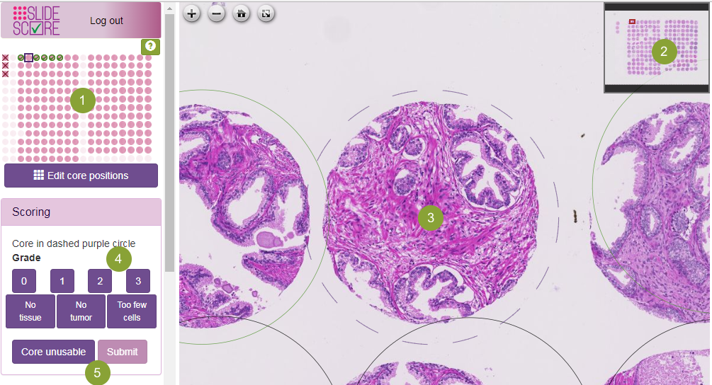 TMA scoring TMA scoring